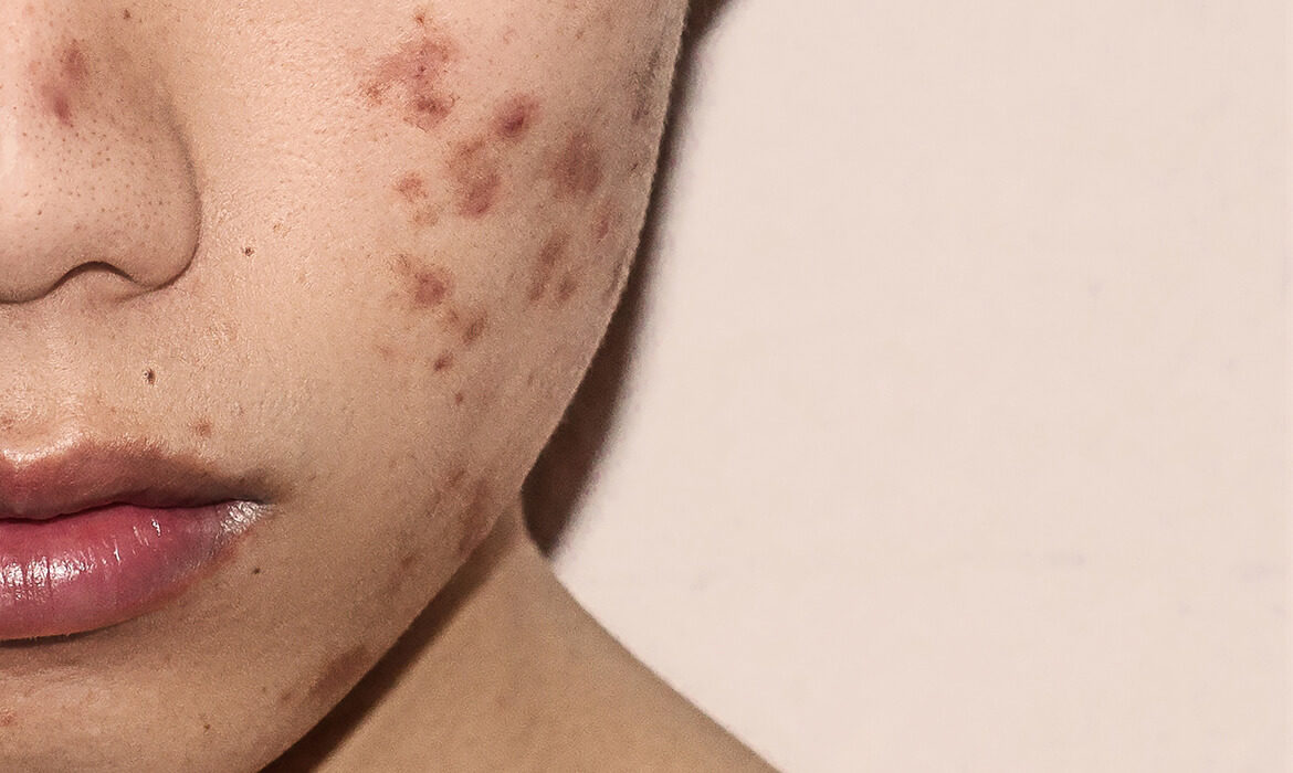 woman acne skin