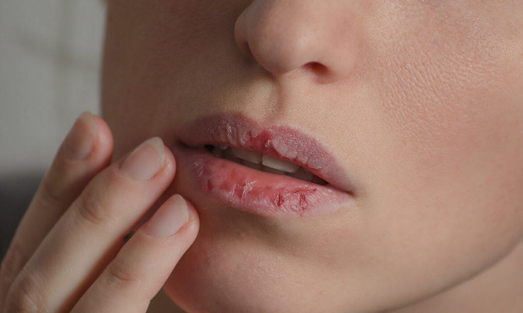 10 Common Causes Of Chapped Lips Lipani Skincare