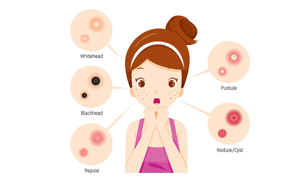 types of pimples
