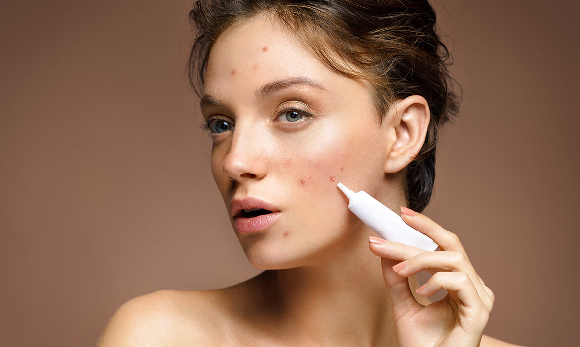woman acne treatment