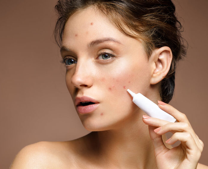 woman acne treatment