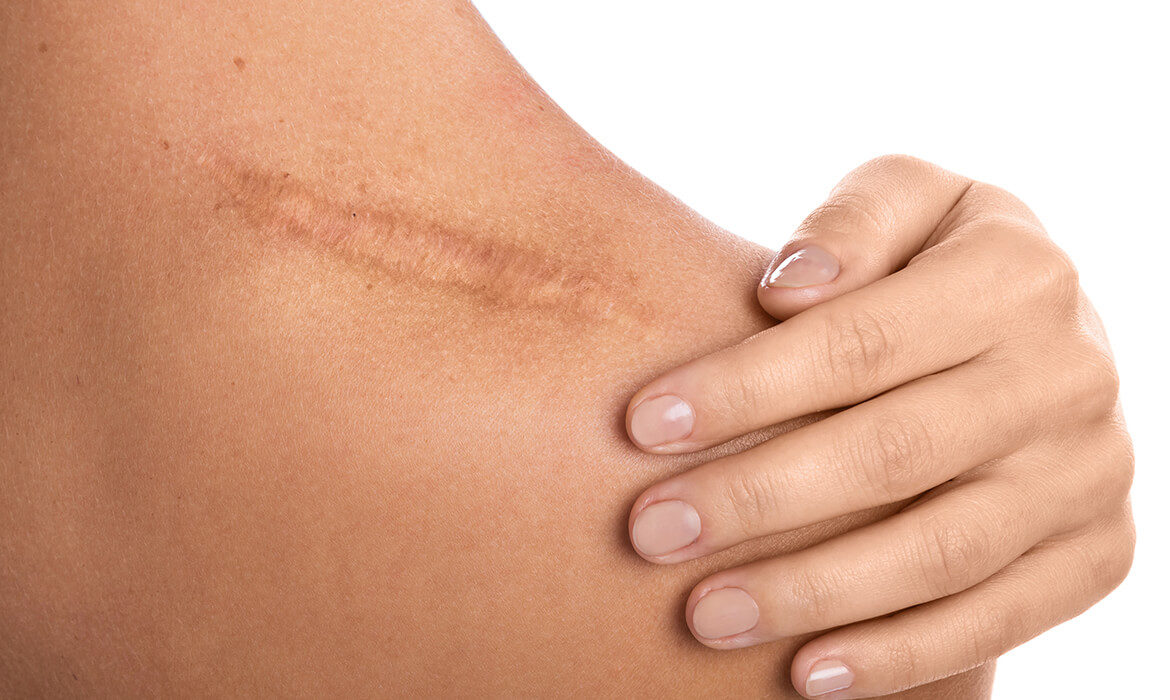 woman scar tissue
